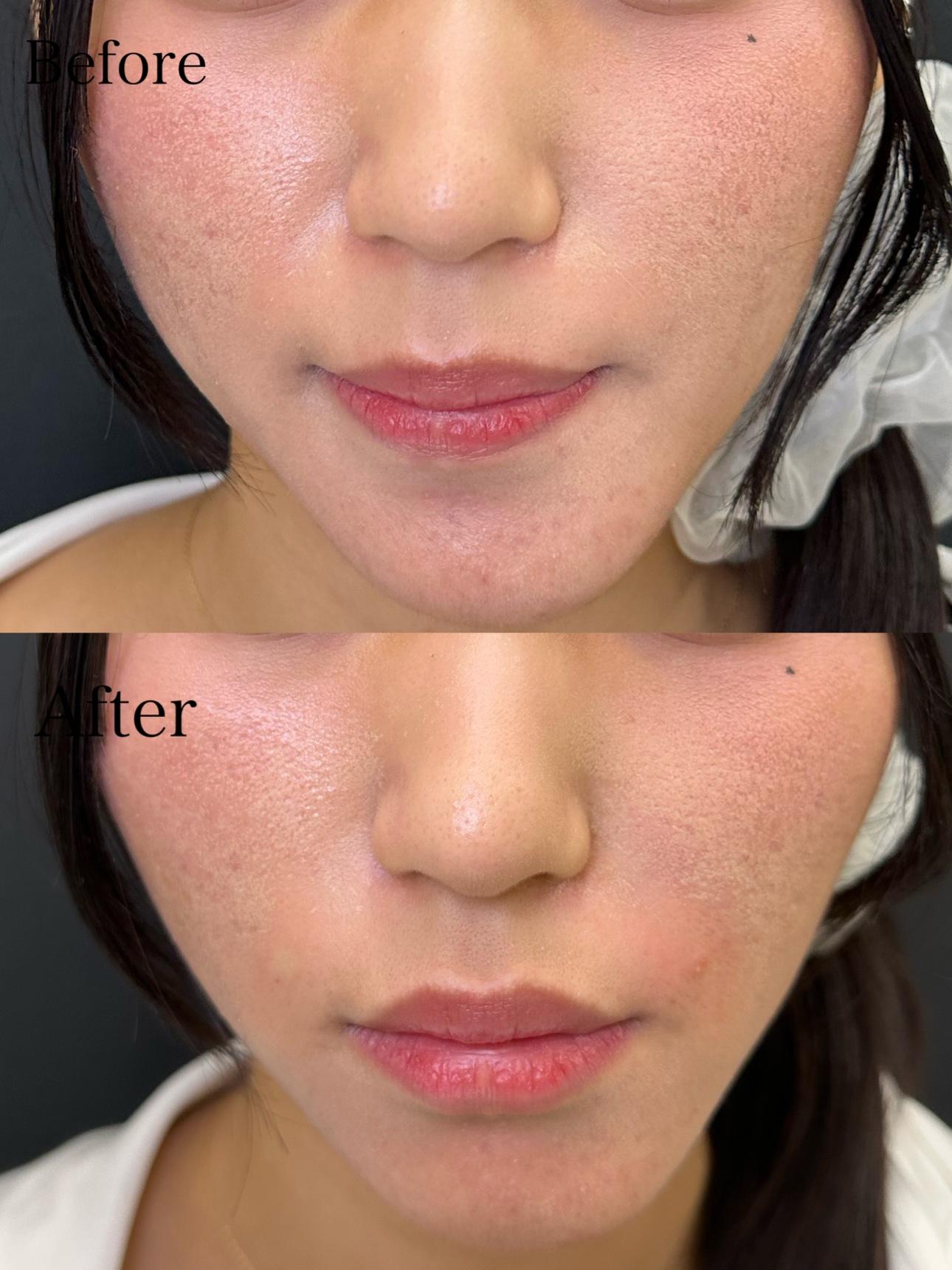 ヒアルロン酸の症例写真