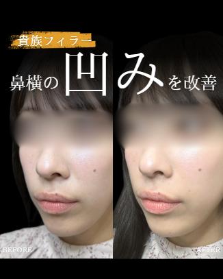 ヒアルロン酸の症例写真