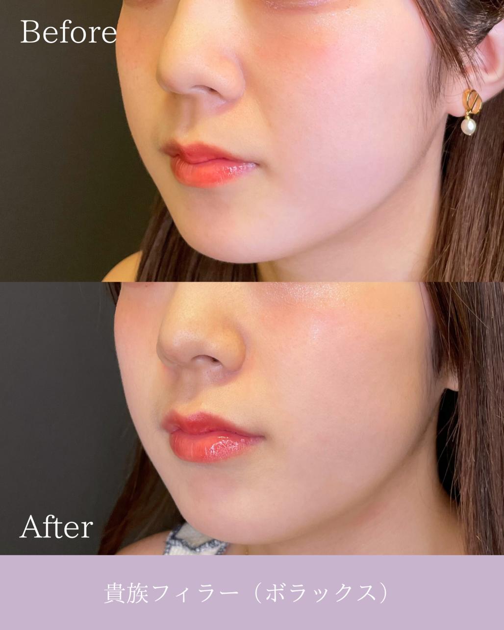 ヒアルロン酸の症例写真