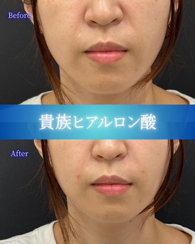 ヒアルロン酸の症例写真