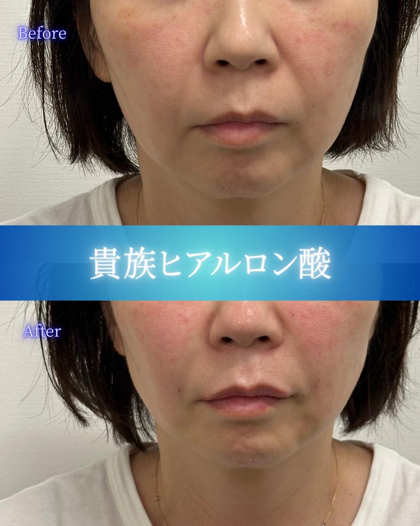 ヒアルロン酸の症例写真