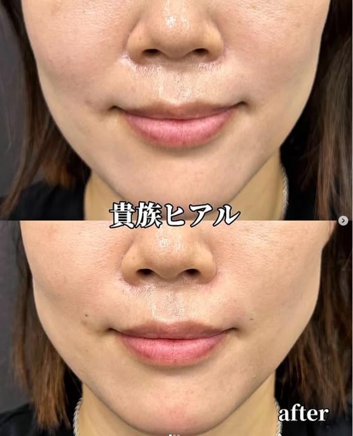 ヒアルロン酸の症例写真