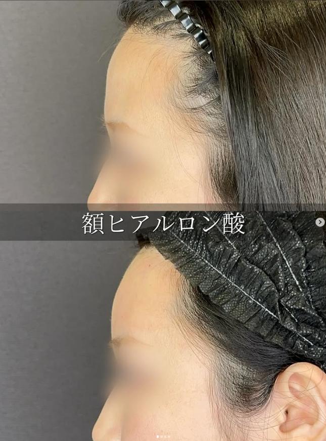 ヒアルロン酸の症例写真
