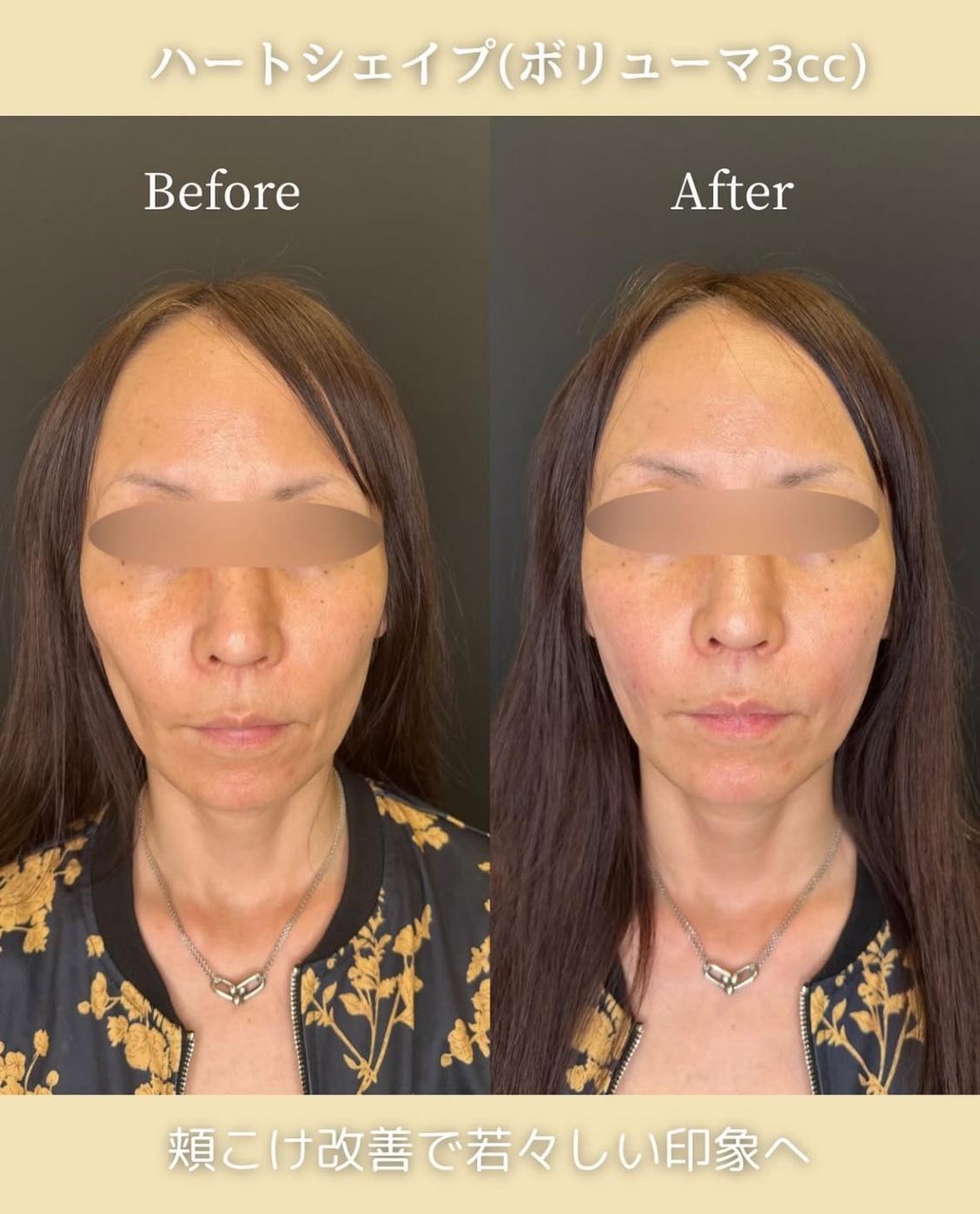 ヒアルロン酸の症例写真