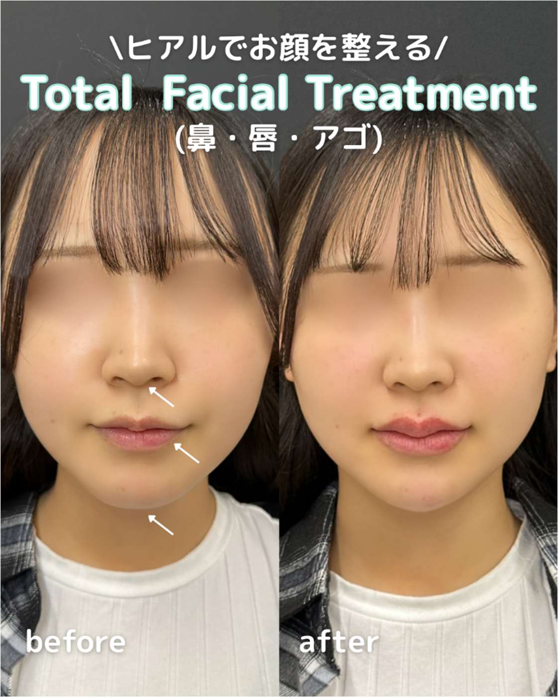 ヒアルロン酸の症例写真