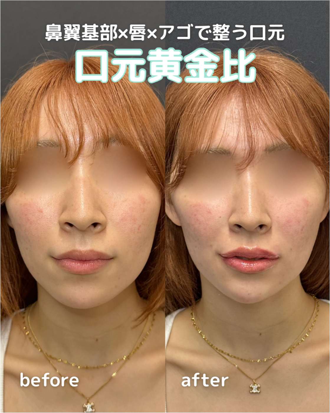 ヒアルロン酸の症例写真