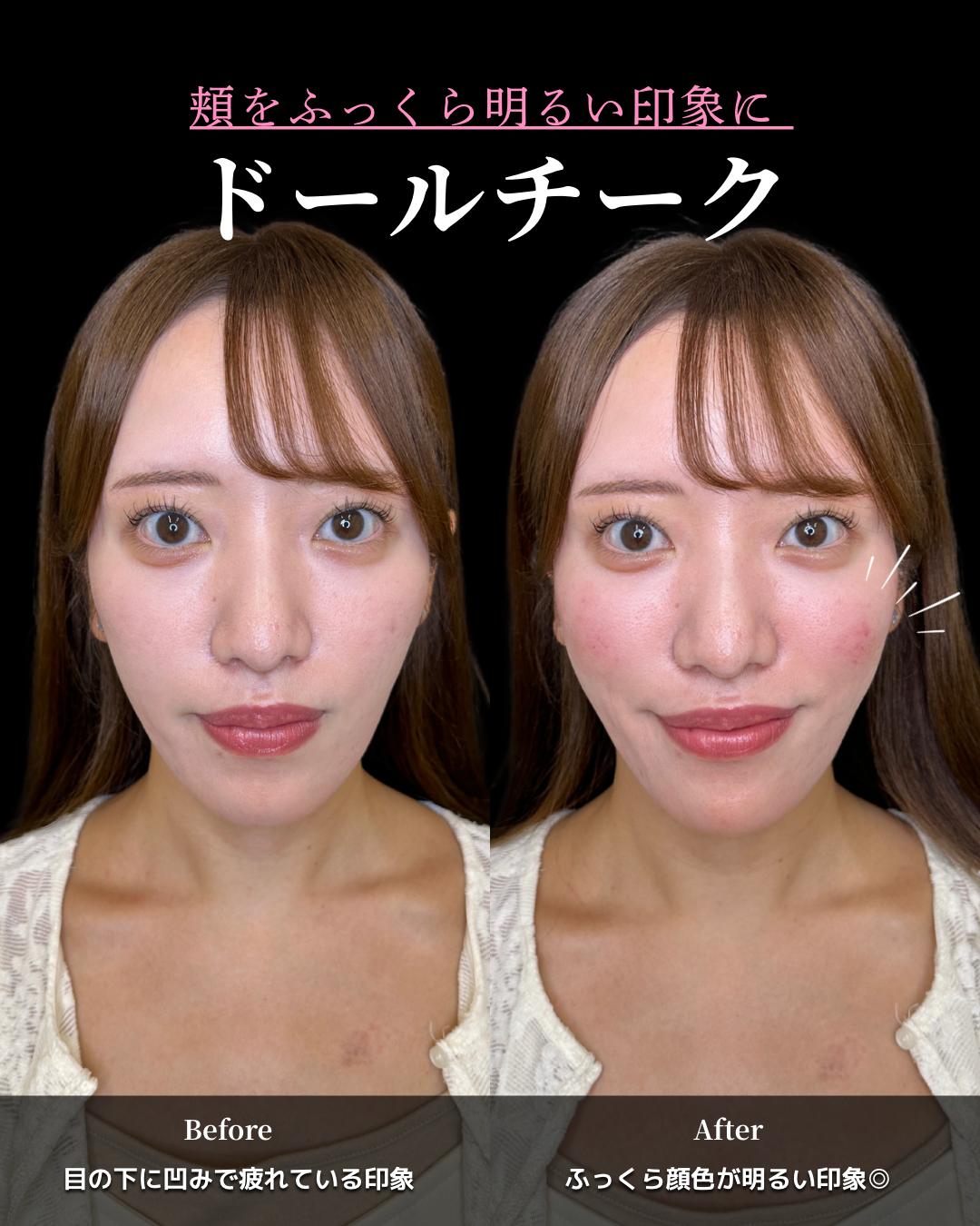 ヒアルロン酸の症例写真