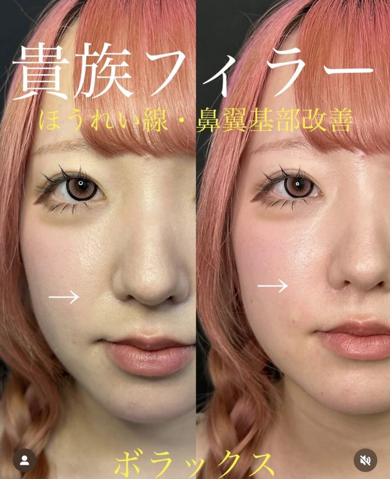 ヒアルロン酸の症例写真