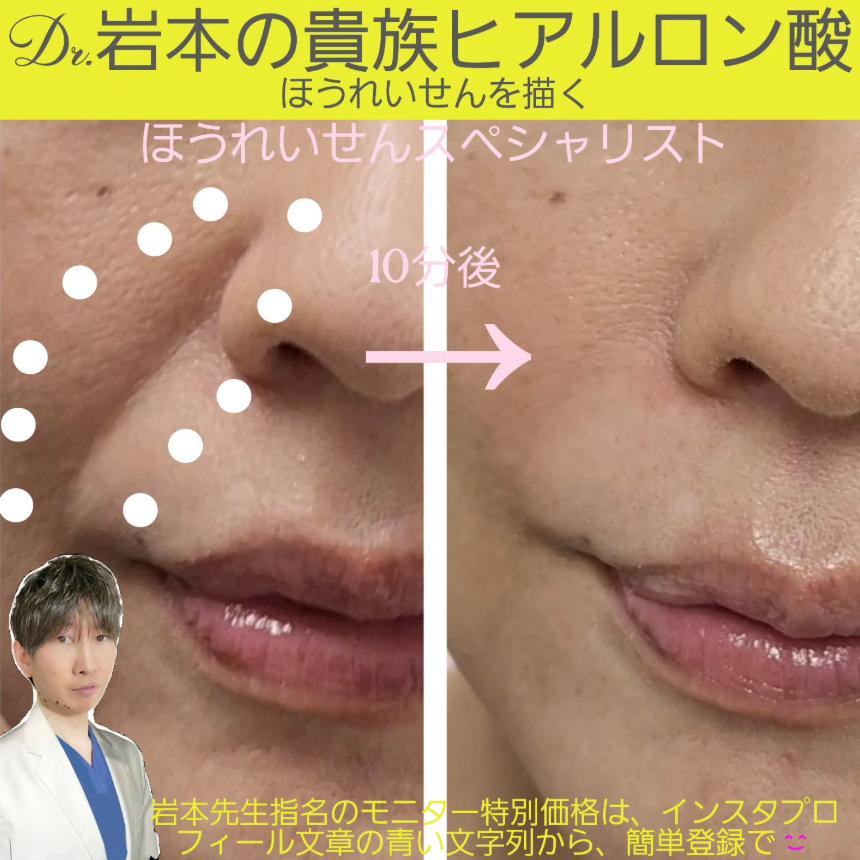 ヒアルロン酸の症例写真