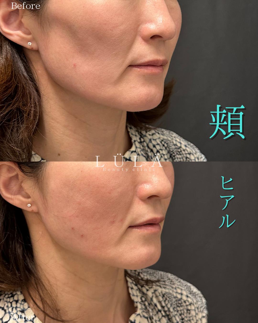 ヒアルロン酸の症例写真