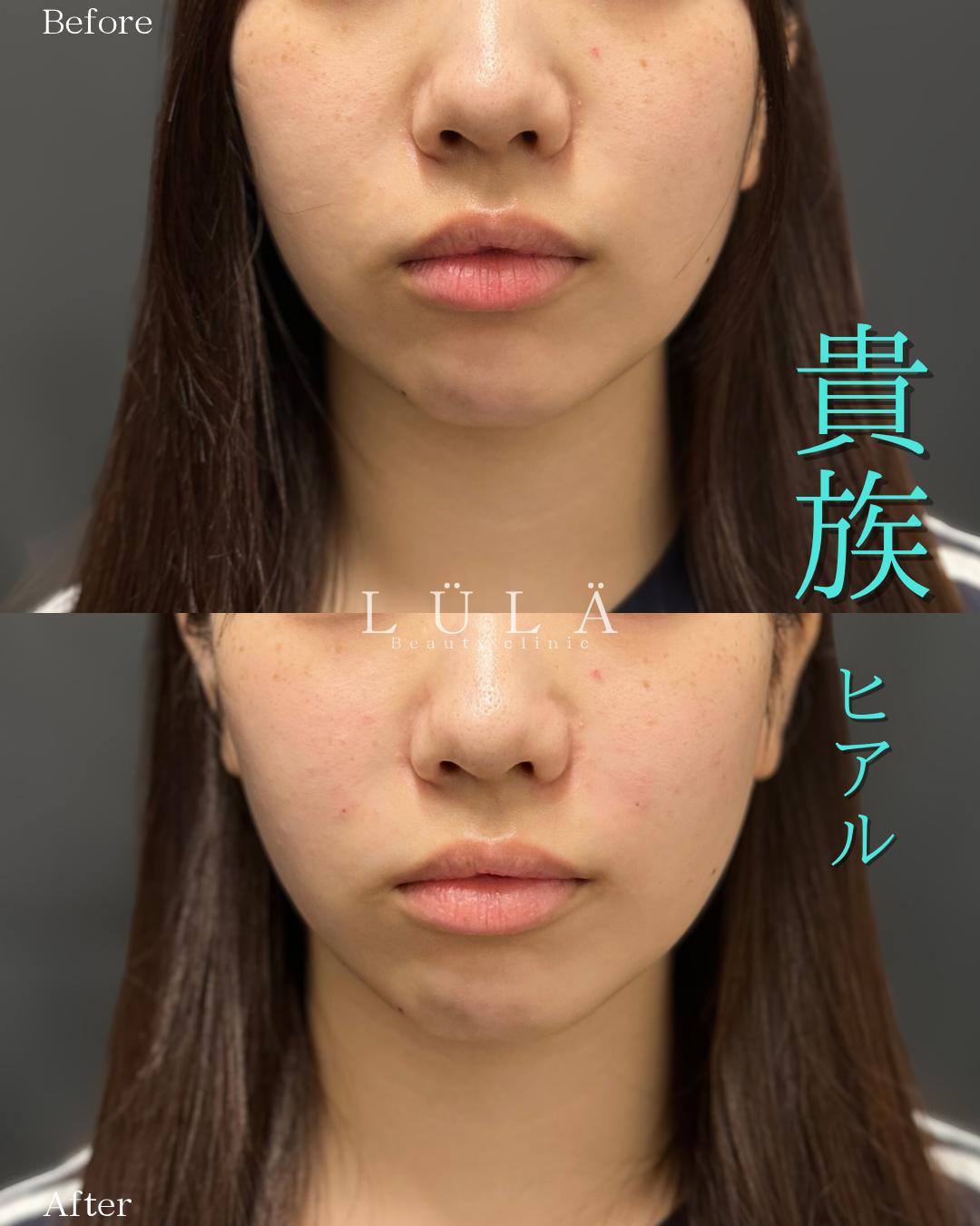 ヒアルロン酸の症例写真