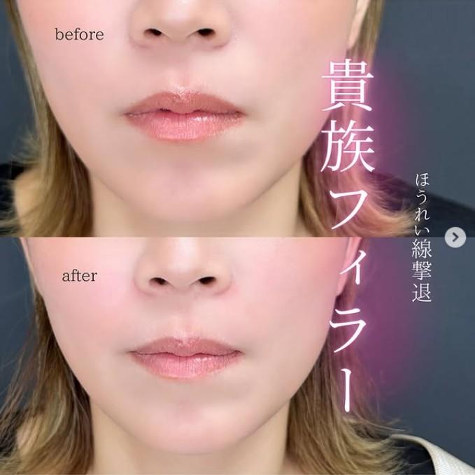 ヒアルロン酸の症例写真