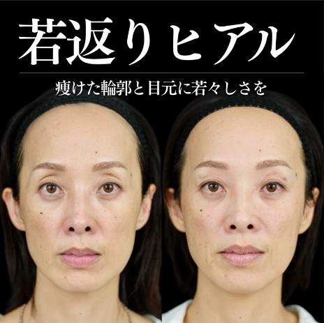ヒアルロン酸の症例写真