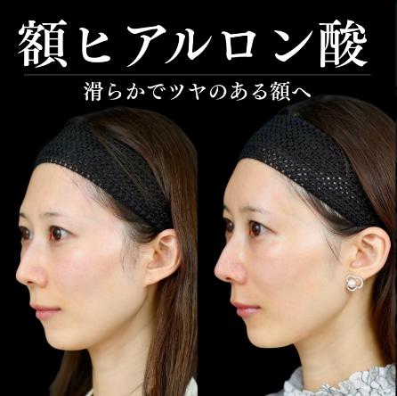 ヒアルロン酸の症例写真