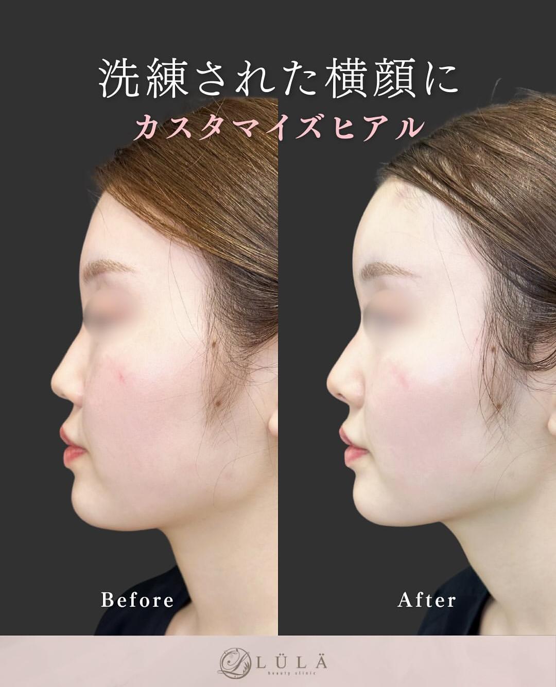 ヒアルロン酸の症例写真