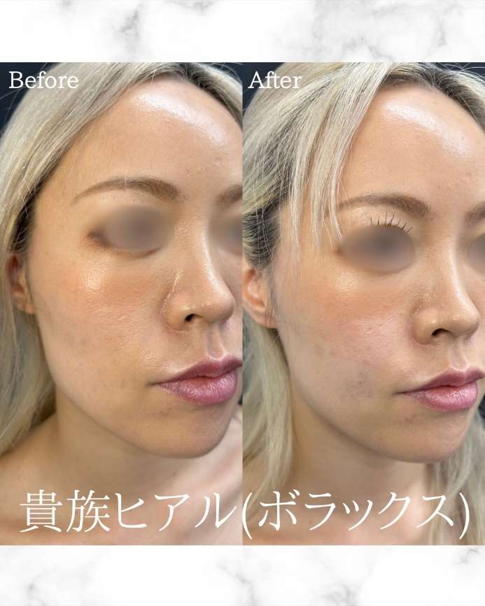 ヒアルロン酸の症例写真
