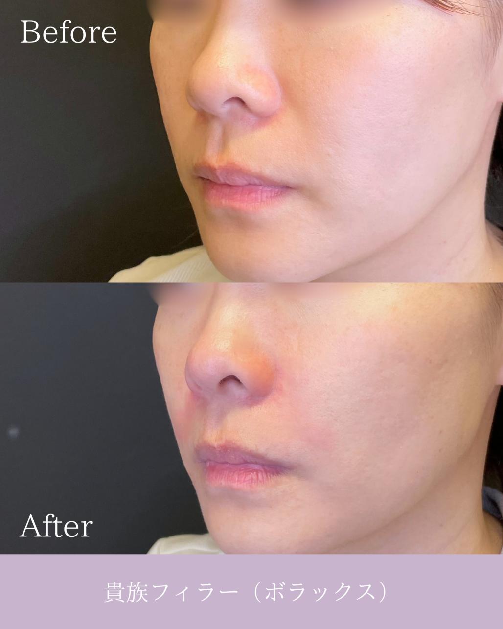 ヒアルロン酸の症例写真