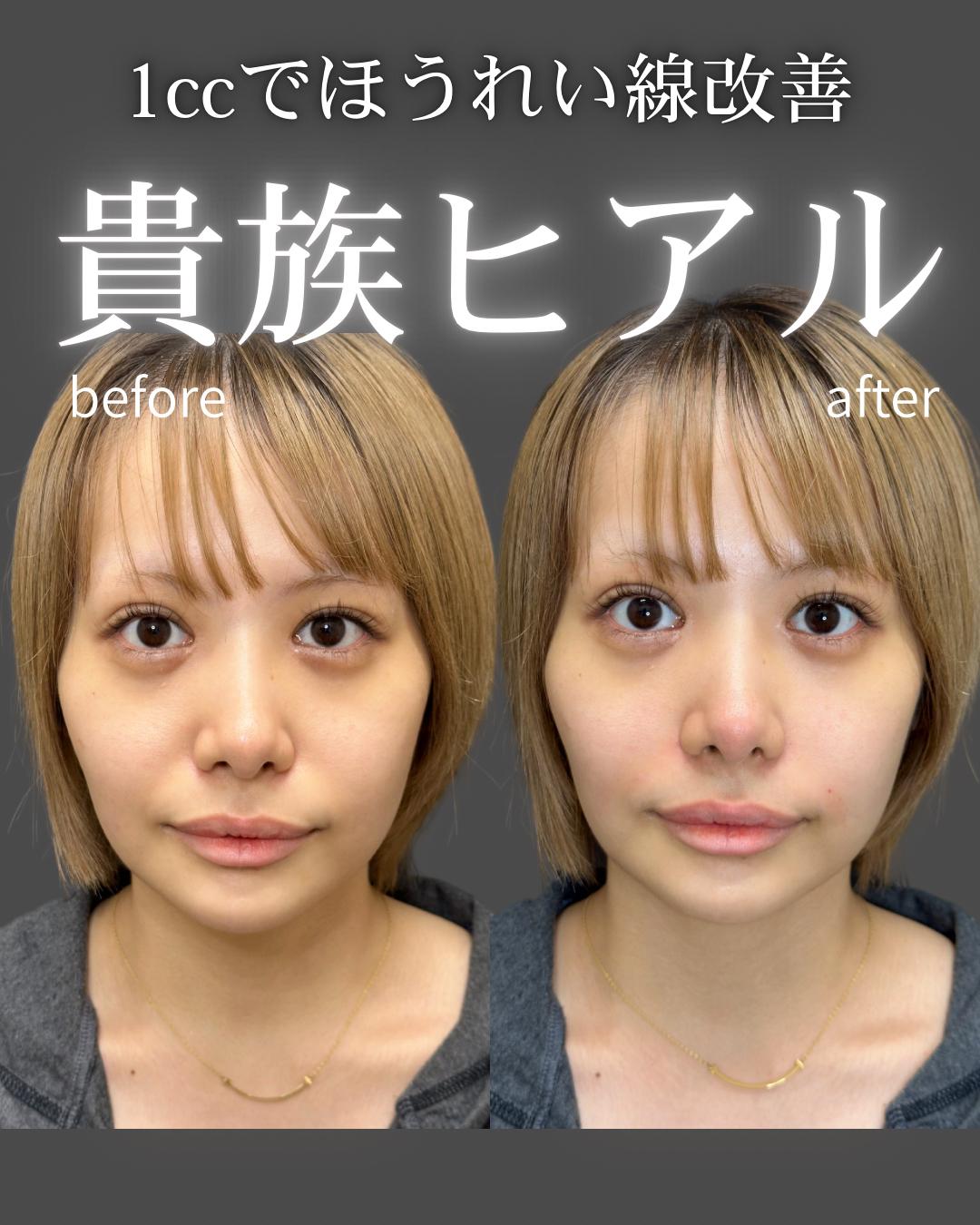 ヒアルロン酸の症例写真