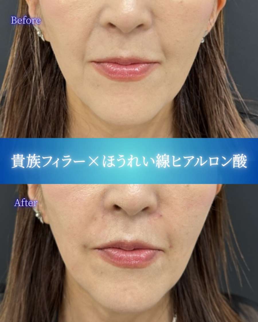 ヒアルロン酸の症例写真