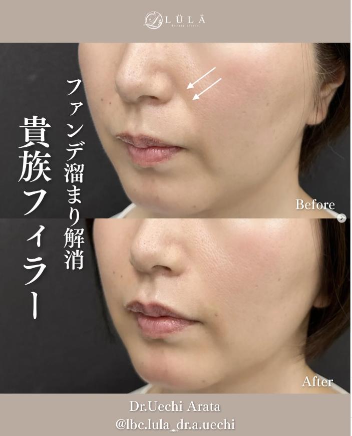 ヒアルロン酸の症例写真