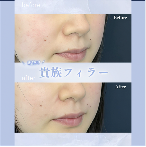 ヒアルロン酸の症例写真