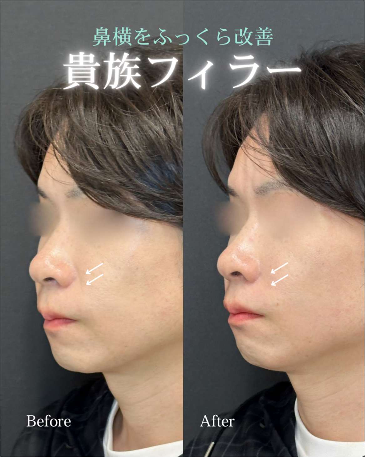 ヒアルロン酸の症例写真