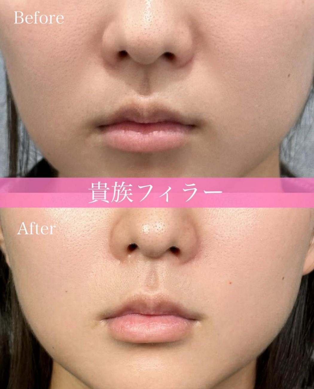 ヒアルロン酸の症例写真