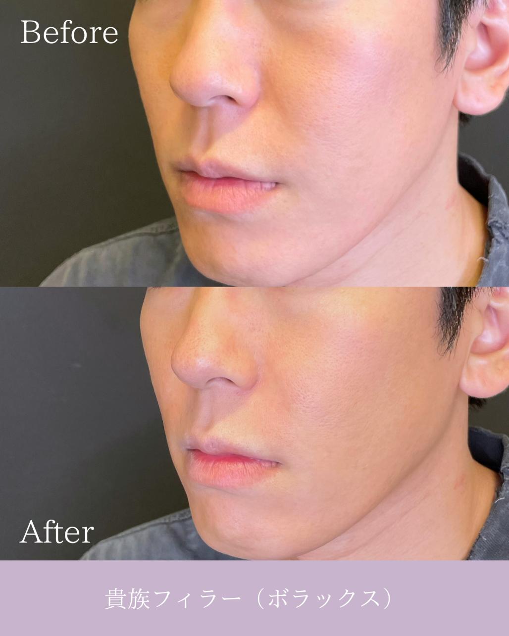 ヒアルロン酸の症例写真