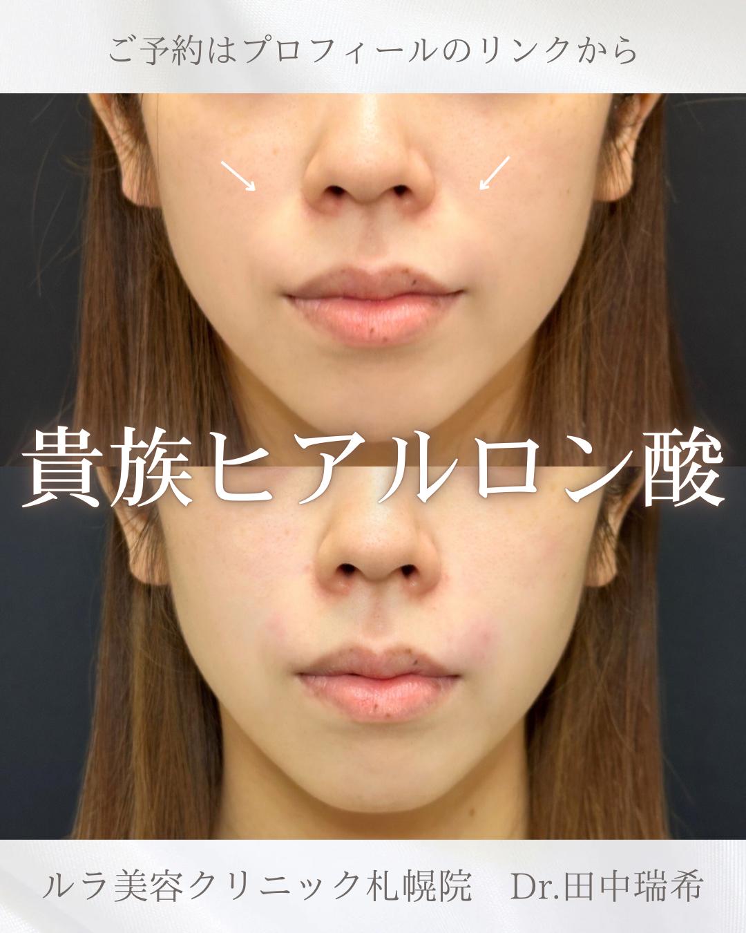 ヒアルロン酸の症例写真