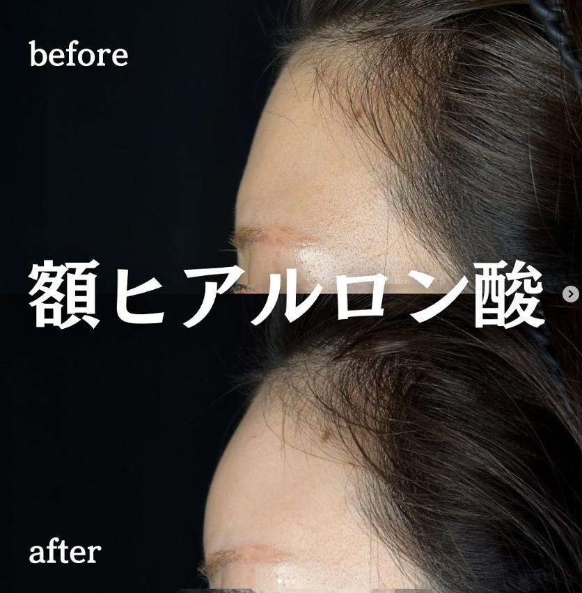 ヒアルロン酸の症例写真