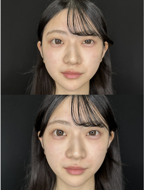 ヒアルロン酸の症例写真