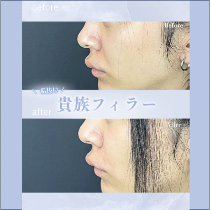 ヒアルロン酸の症例写真