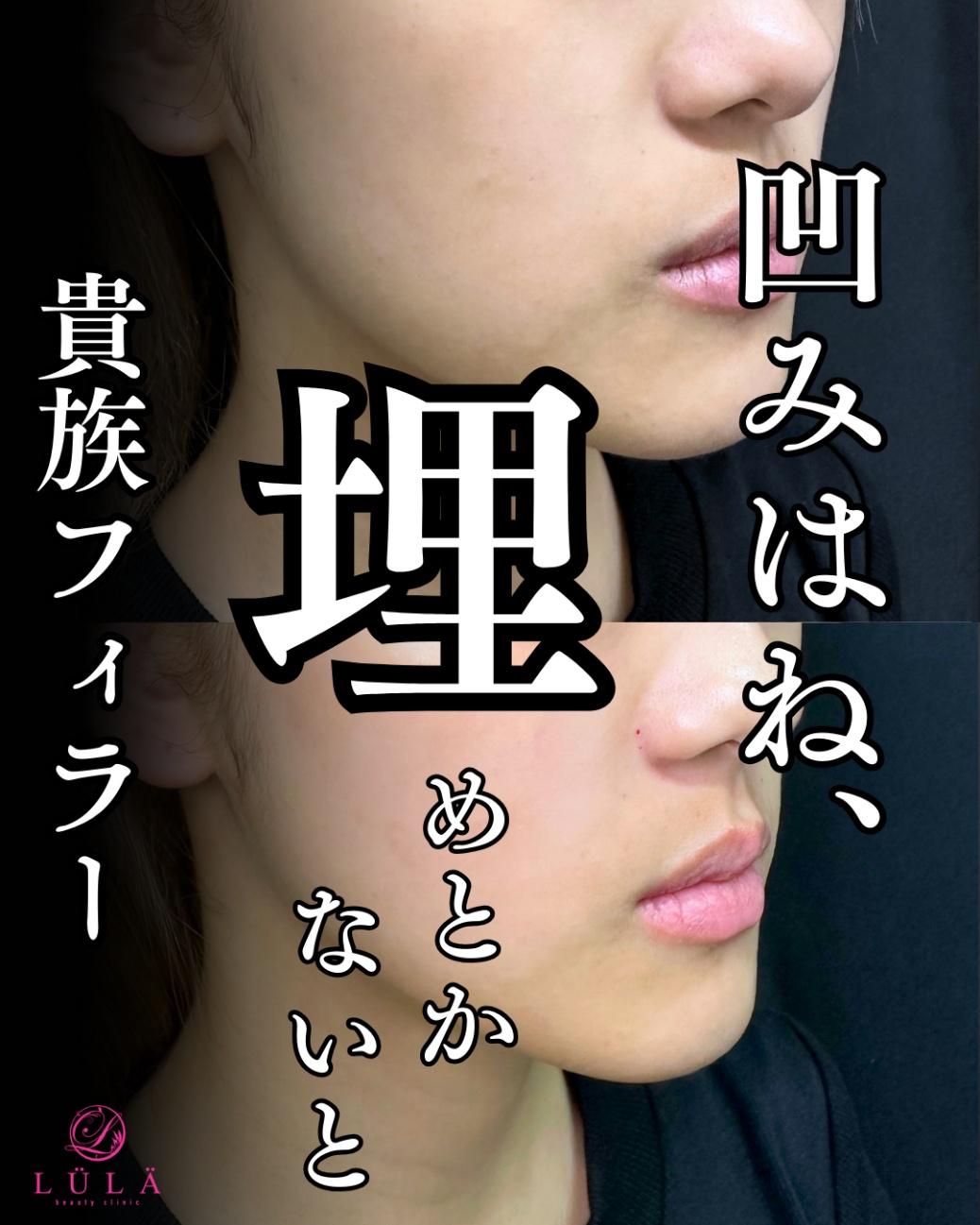 ヒアルロン酸の症例写真