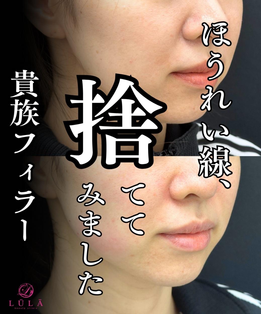 ヒアルロン酸の症例写真