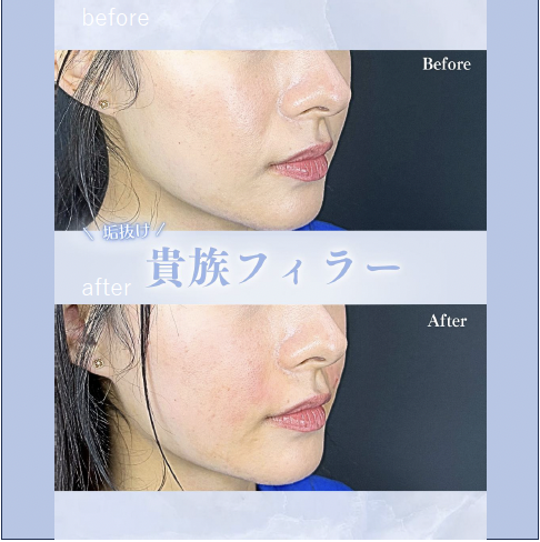 ヒアルロン酸の症例写真