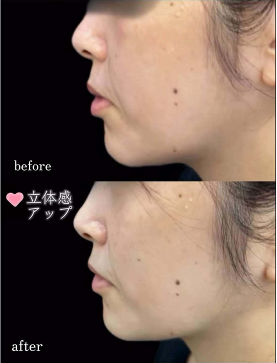 ヒアルロン酸の症例写真