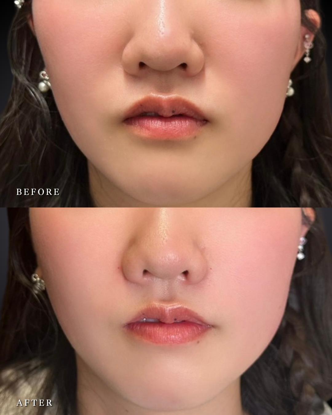 ヒアルロン酸の症例写真