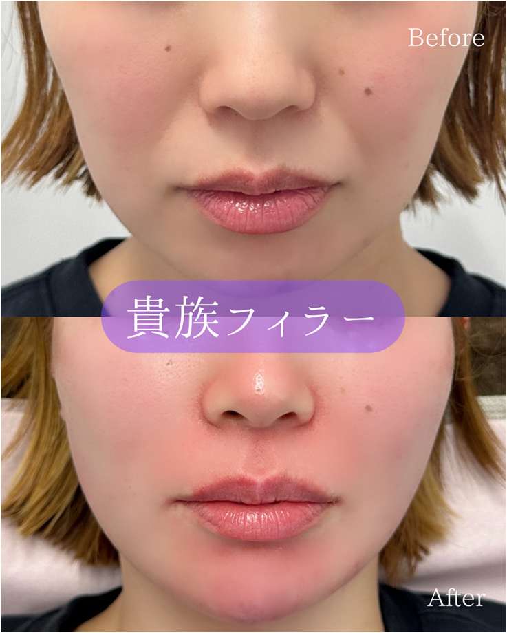 ヒアルロン酸の症例写真