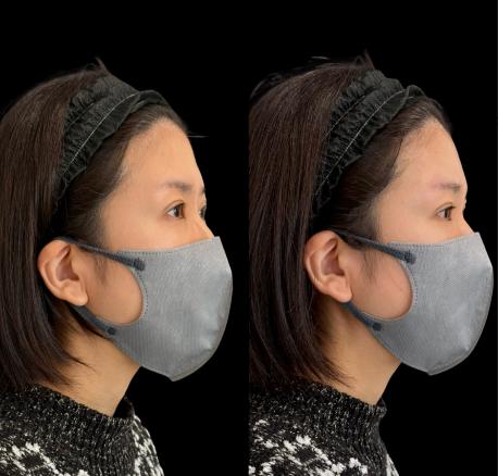 ヒアルロン酸の症例写真