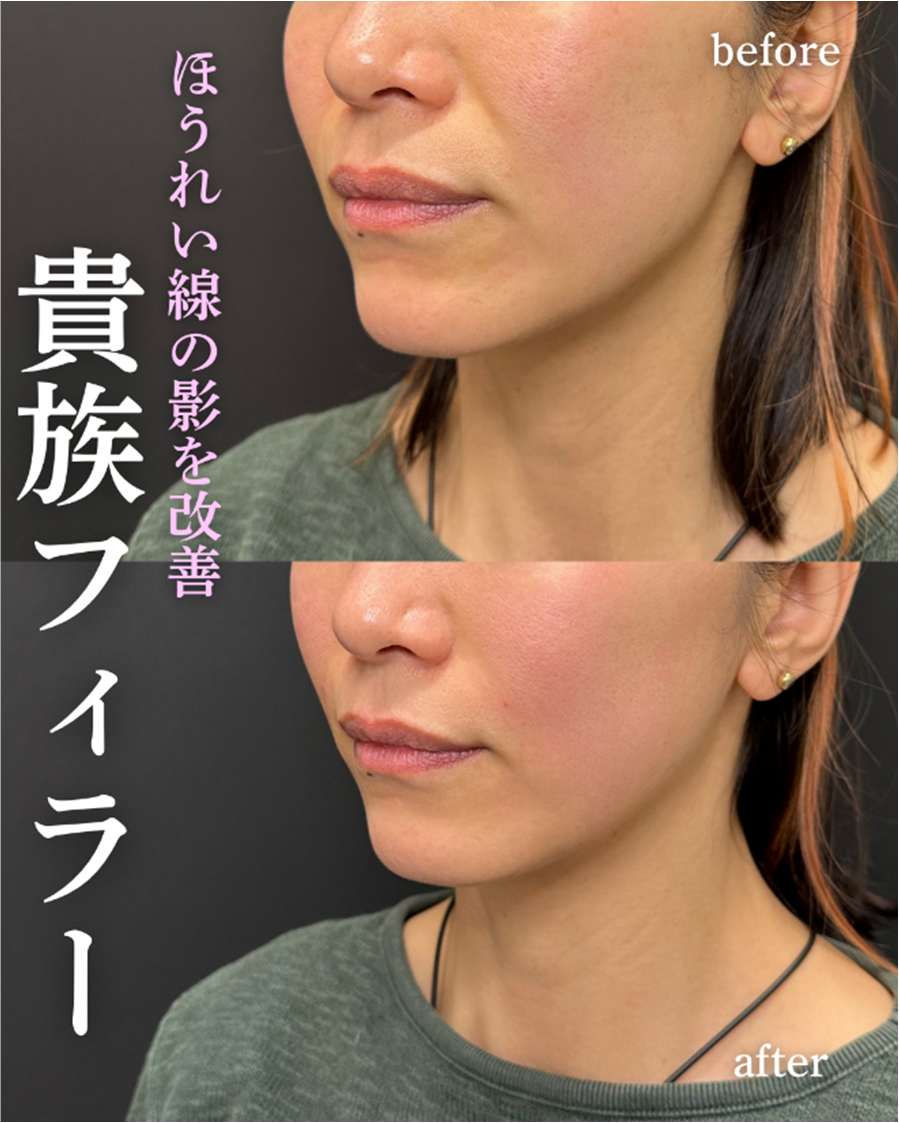 ヒアルロン酸の症例写真