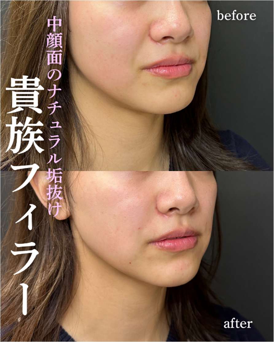 ヒアルロン酸の症例写真