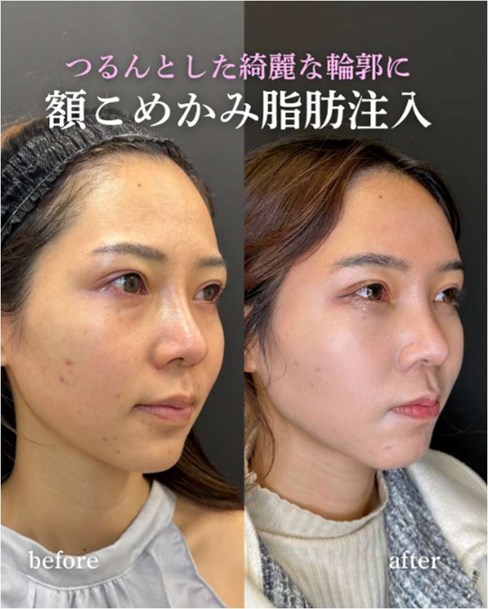 ヒアルロン酸の症例写真