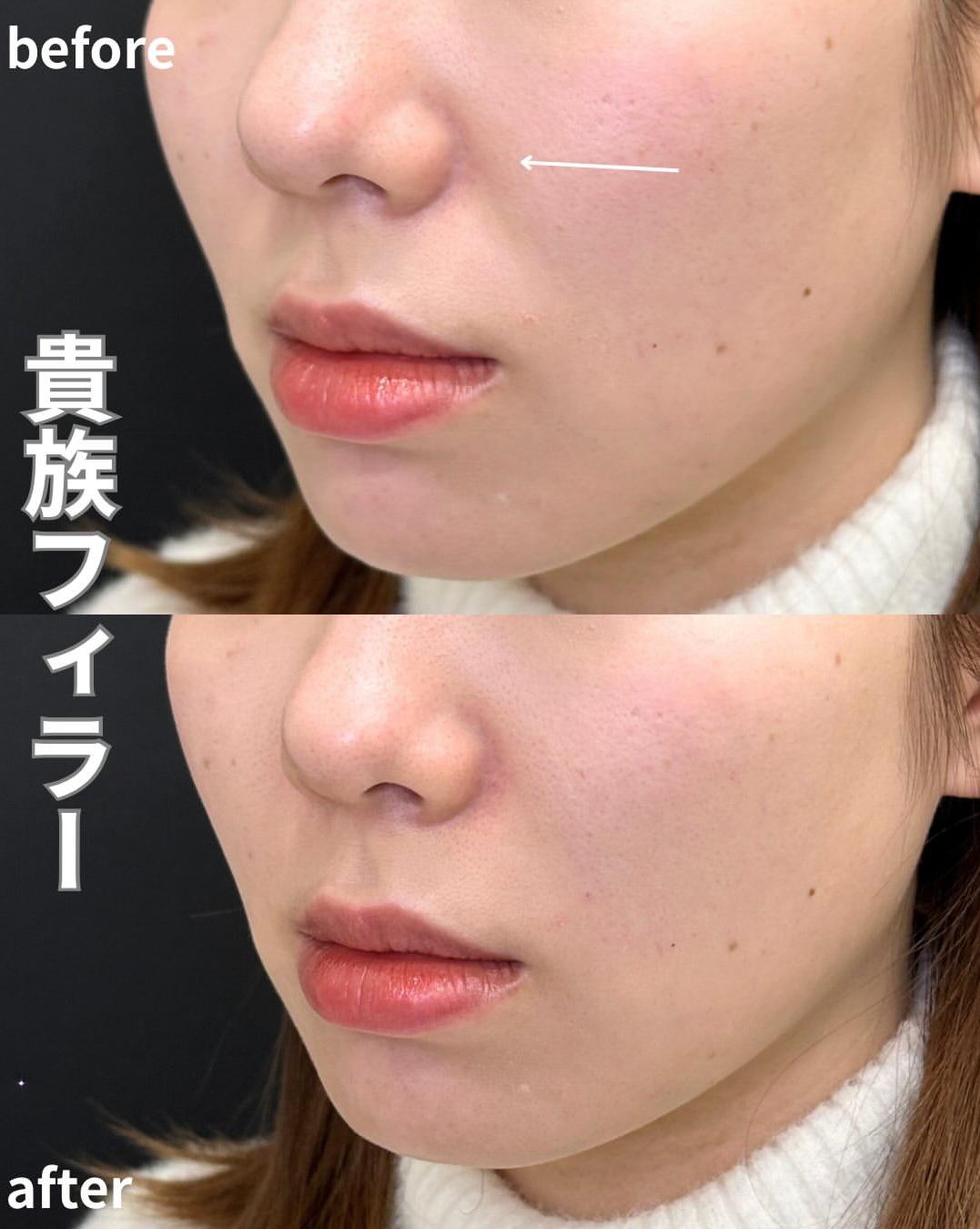 ヒアルロン酸の症例写真