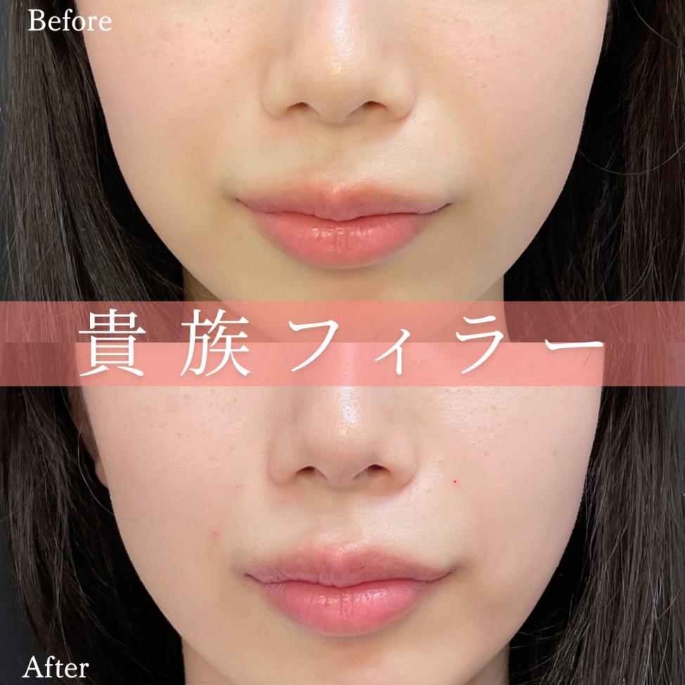 ヒアルロン酸の症例写真