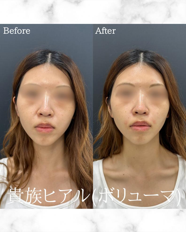 ヒアルロン酸の症例写真