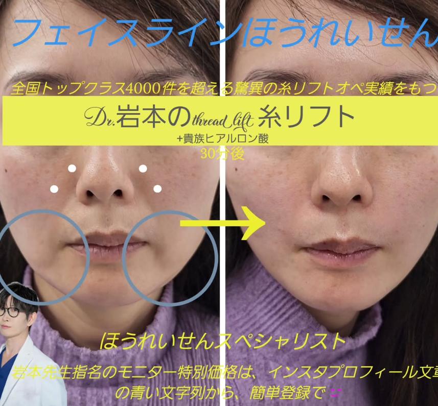 ヒアルロン酸の症例写真