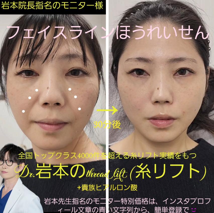 ヒアルロン酸の症例写真