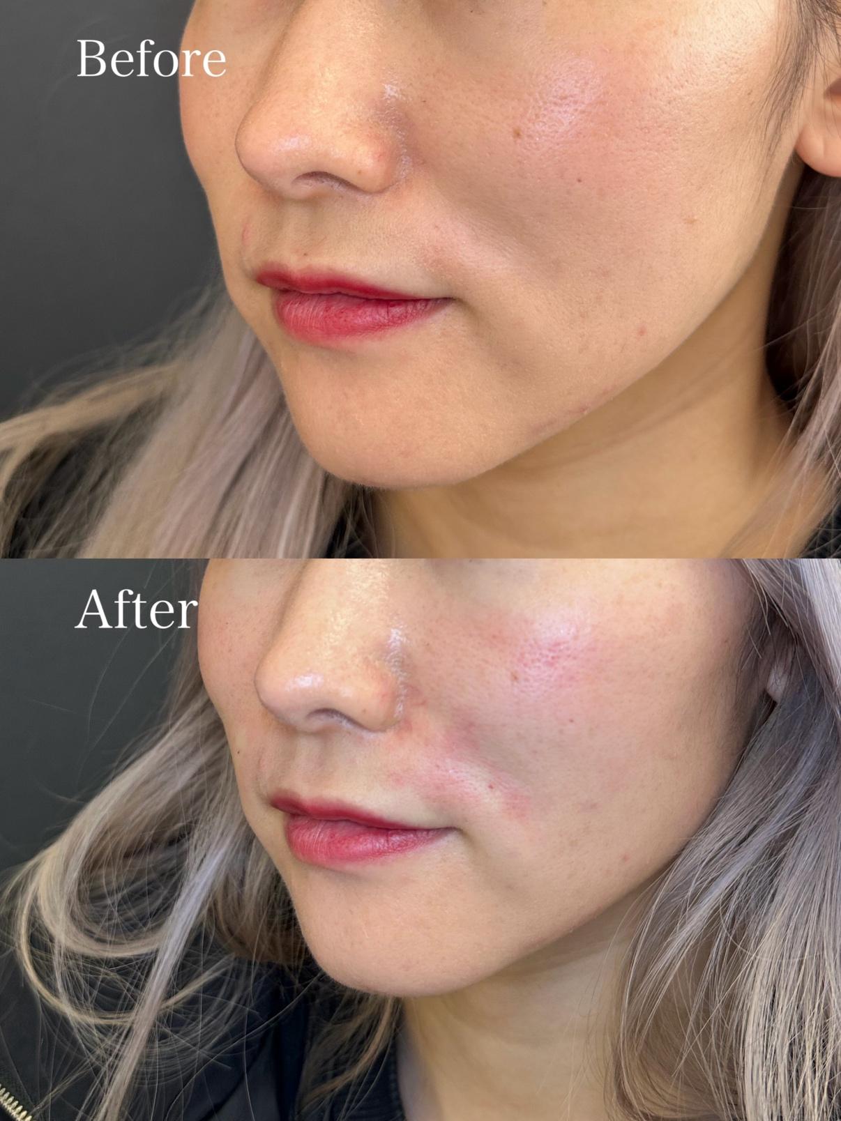 ヒアルロン酸の症例写真