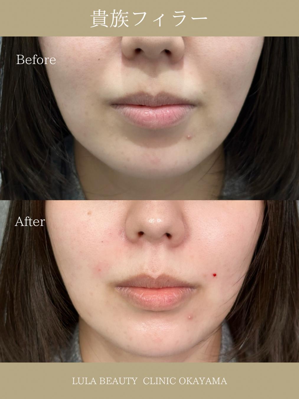 ヒアルロン酸の症例写真