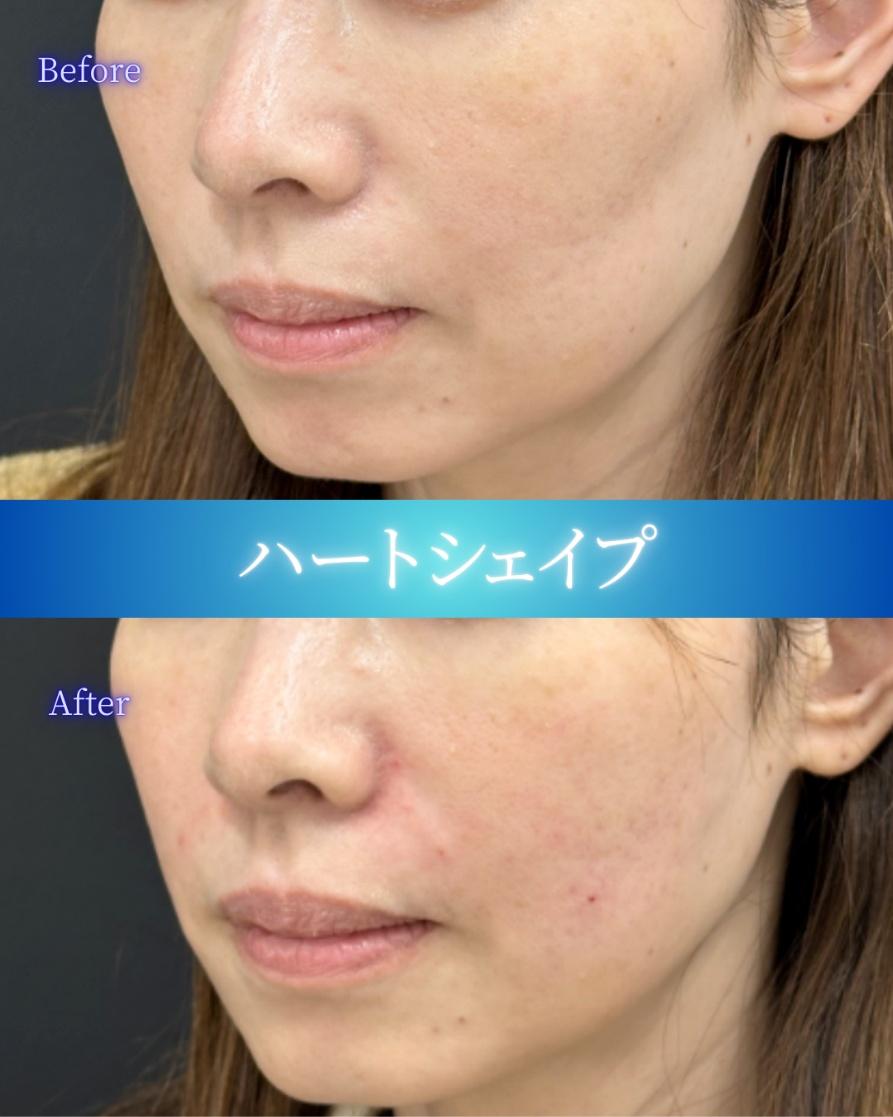 ヒアルロン酸の症例写真